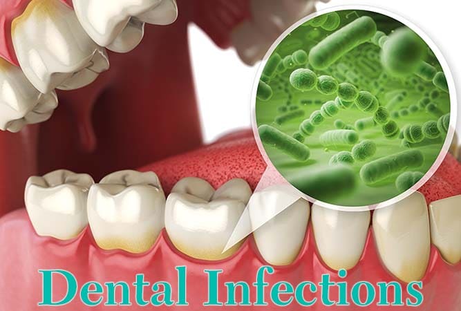 Treatment For Dental Infections