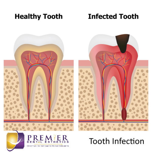 Treatment For Dental Infections